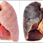 Bài thuốc có một không hai ‘cứu’ phổi người nghiện thuốc lá